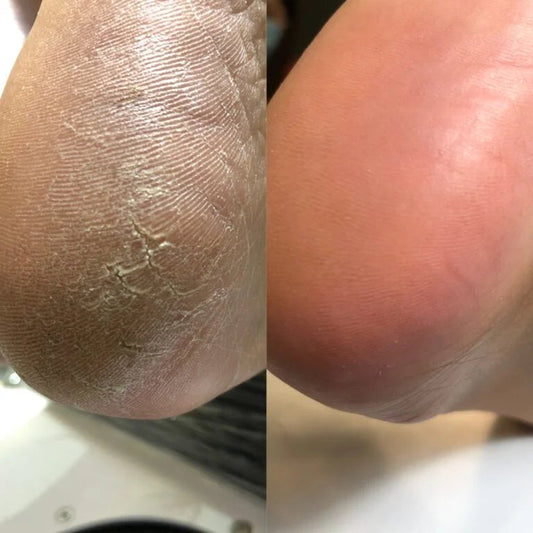 Nailsoftheday Podology+ Keratolytic for feet, urea 20%, 100 ml.