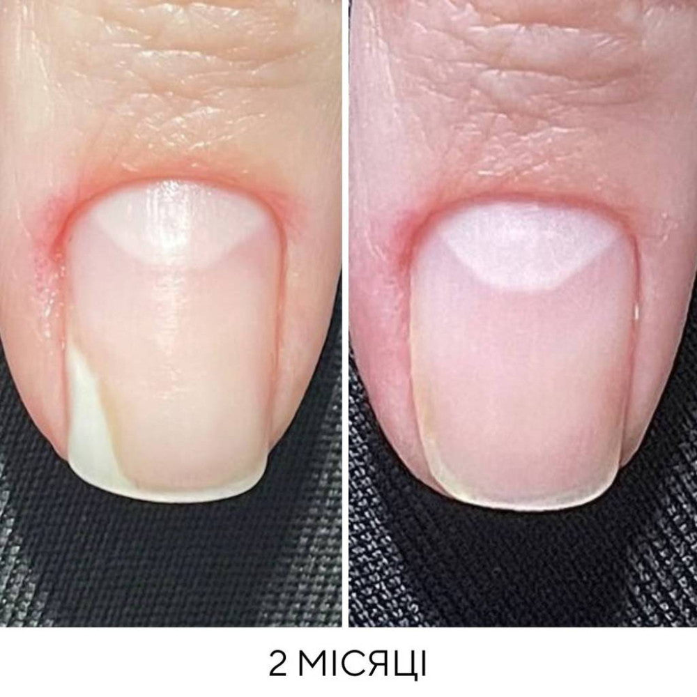 NAILSOFTHEDAY ONISTOP – a regenerating oil against onycholysis, 15 ml