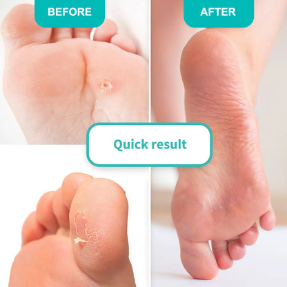 FOOT CALLUS SOFTENING GEL  For topical application 100 ml