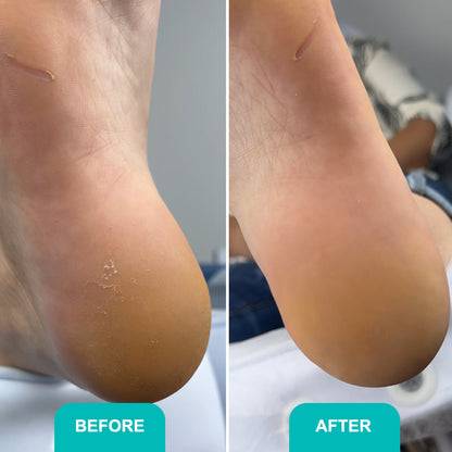 SOFT BLADE CALLUSE AND CORNS SOFTENING GEL For smooth, hydrated, and callus-free feet 200 ml