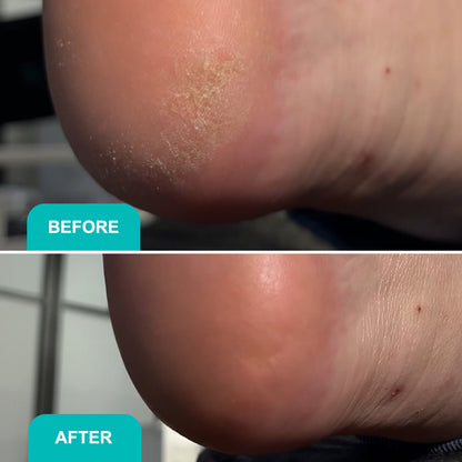 SOFT BLADE CALLUSE AND CORNS SOFTENING GEL For smooth, hydrated, and callus-free feet 200 ml