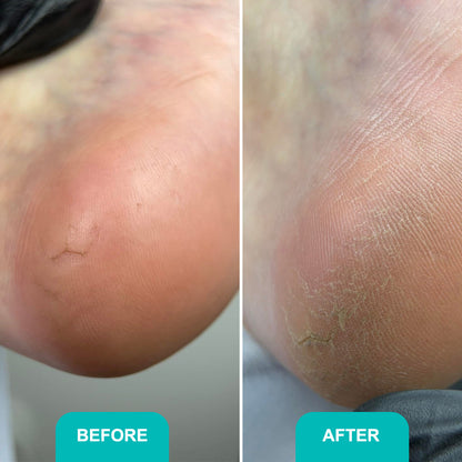 SOFT BLADE CALLUSE AND CORNS SOFTENING GEL For smooth, hydrated, and callus-free feet 200 ml