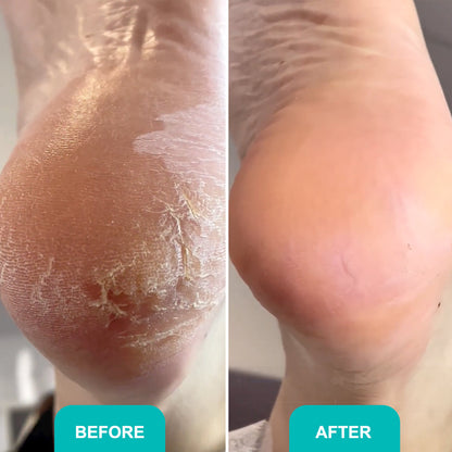 FOAM EXPRESS SOFTENER  Fast, effective relief for rough, callused feet 150 ml