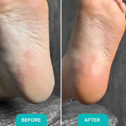FOAM EXPRESS SOFTENER  Fast, effective relief for rough, callused feet 150 ml